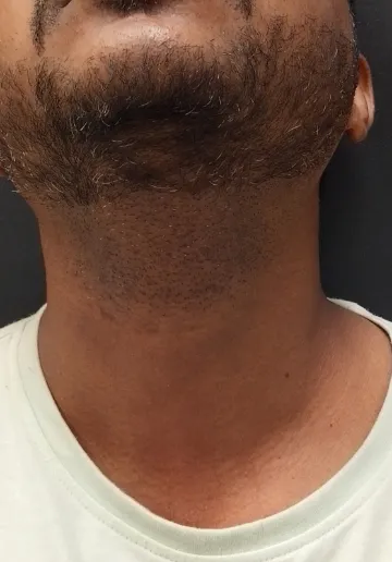 Wart Removal Before and after results at Dermatrix Clinic