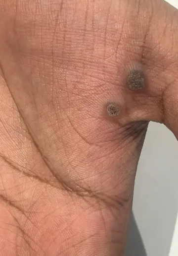 Wart Removal Before and after results at Dermatrix Clinic
