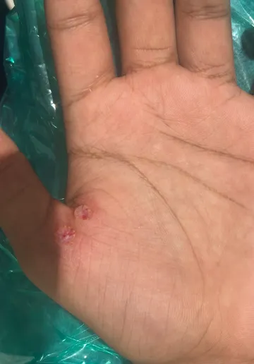 Wart Removal Before and after results at Dermatrix Clinic
