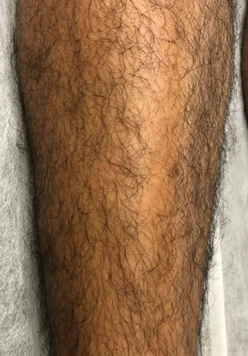 Leg Laser Hair Removal Before and after results at Dermatrix Clinic