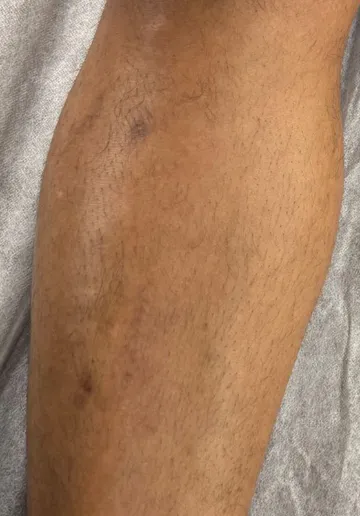 Leg Laser Hair Removal Before and after results at Dermatrix Clinic