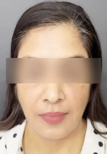 Cosmelan Peel Before and after results at Dermatrix Clinic