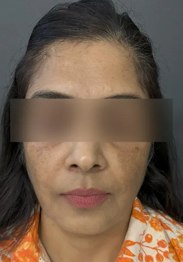 Cosmelan Peel Before and after results at Dermatrix Clinic