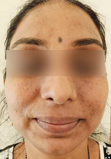 Cosmelan Peel Before and after results at Dermatrix Clinic