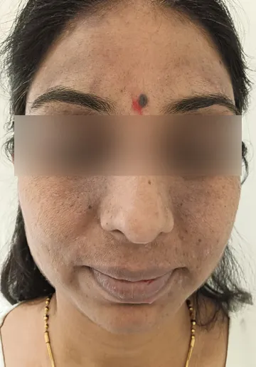 Cosmelan Peel Before and after results at Dermatrix Clinic