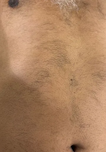 Laser Hair Removal Before and after results at Dermatrix Clinic
