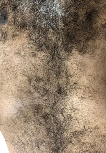 Laser Hair Removal Before and after results at Dermatrix Clinic