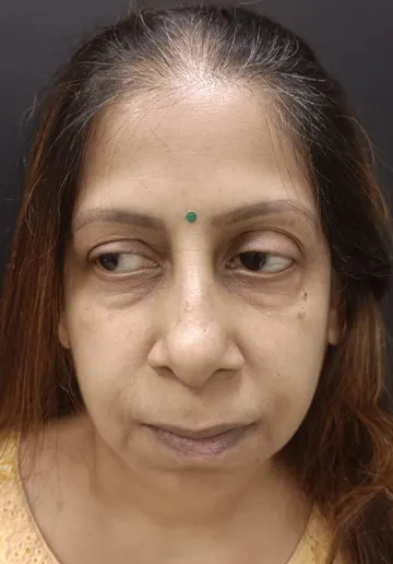 Microblading Eyebrows Before and after results at Dermatrix Clinic