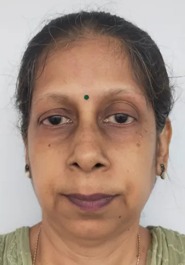 Microblading Eyebrows Before and after results at Dermatrix Clinic