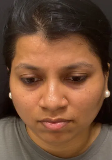 Microblading Eyebrows Before and after results at Dermatrix Clinic
