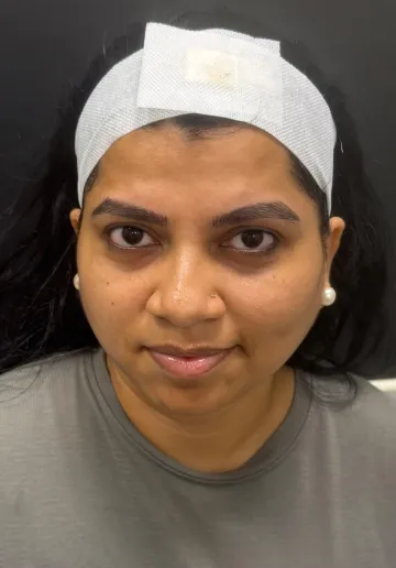 Microblading Eyebrows Before and after results at Dermatrix Clinic