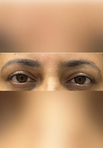 Microblading Eyebrows Before and after results at Dermatrix Clinic