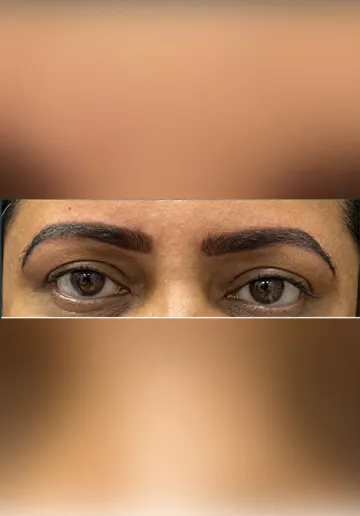 Microblading Eyebrows Before and after results at Dermatrix Clinic