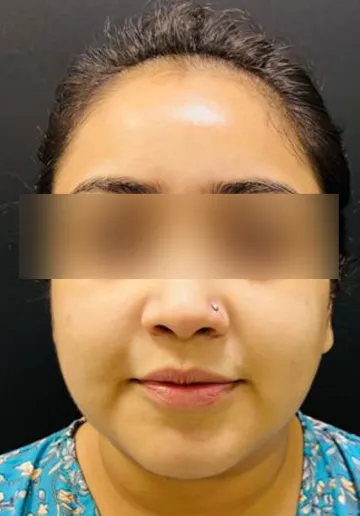 Thread Lifting Before and after results at Dermatrix Clinic