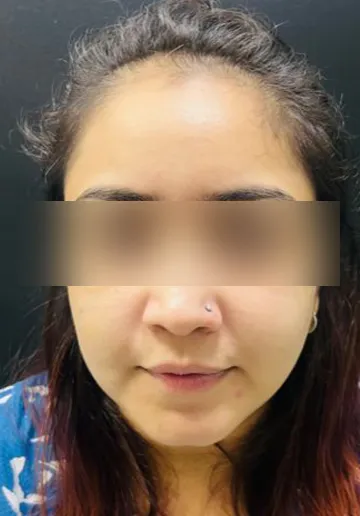 Thread Lifting Before and after results at Dermatrix Clinic