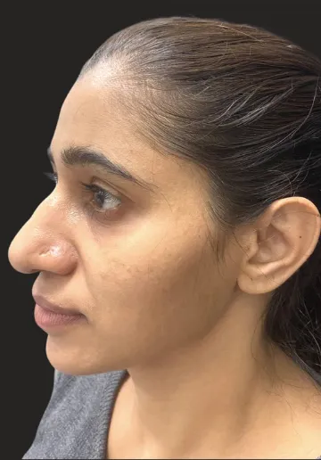 Dermal Fillers Before and after results at Dermatrix Clinic