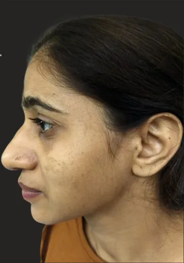 Dermal Fillers Before and after results at Dermatrix Clinic