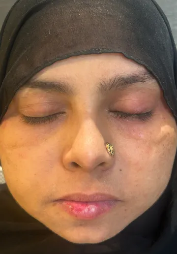 Cyst Removal Before and after results at Dermatrix Clinic