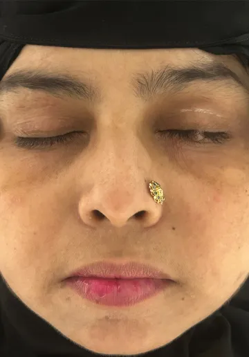 Cyst Removal Before and after results at Dermatrix Clinic