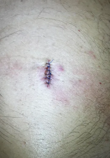 Cyst Removal Before and after results at Dermatrix Clinic