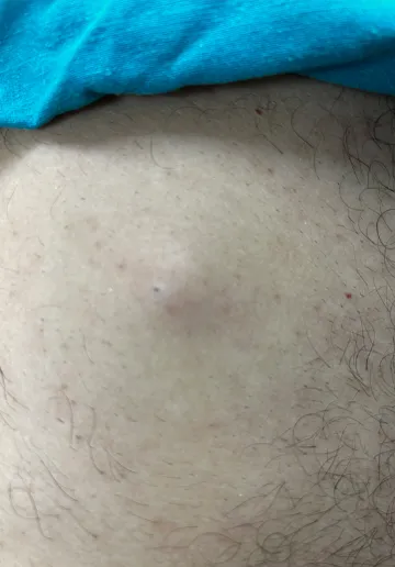 Cyst Removal Before and after results at Dermatrix Clinic