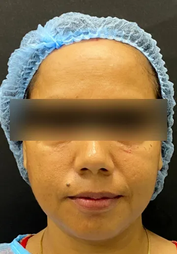 Dermal Fillers Before and after results at Dermatrix Clinic