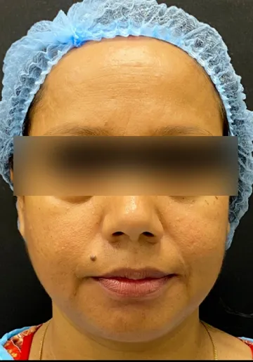 Dermal Fillers Before and after results at Dermatrix Clinic