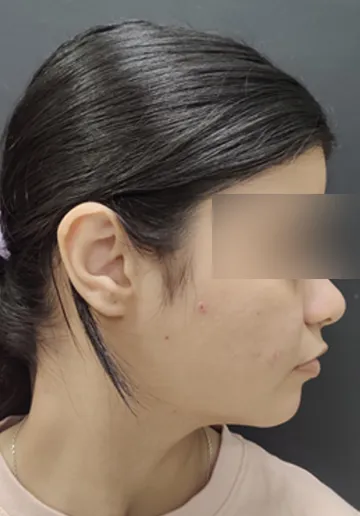 Ear Piercing Before and after results at Dermatrix Clinic