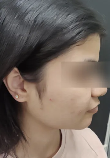 Ear Piercing Before and after results at Dermatrix Clinic