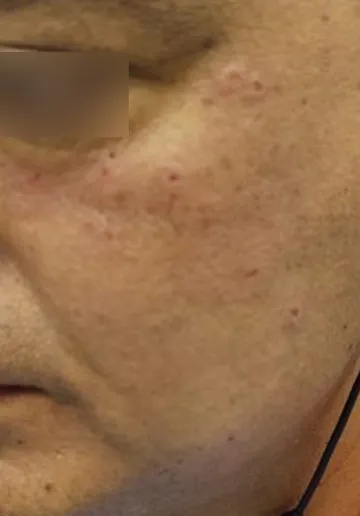 Wart Removal Before and after results at Dermatrix Clinic