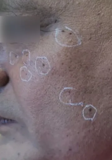 Wart Removal Before and after results at Dermatrix Clinic