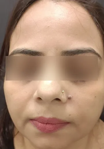 Mole Removal Before and after results at Dermatrix Clinic