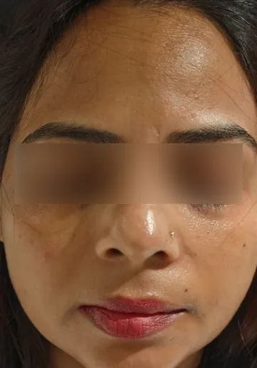 Mole Removal Before and after results at Dermatrix Clinic