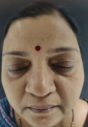 Xanthelasma Removal Before and after results at Dermatrix Clinic
