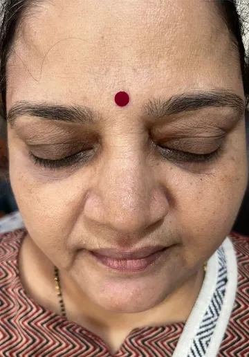 Xanthelasma Removal Before and after results at Dermatrix Clinic