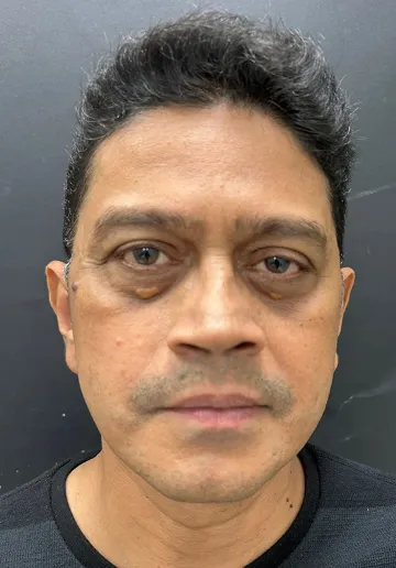Xanthelasma Removal Before and after results at Dermatrix Clinic