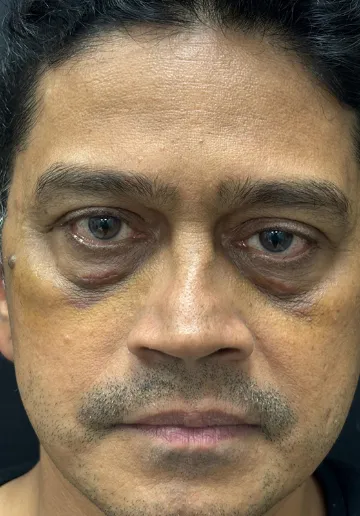 Xanthelasma Removal Before and after results at Dermatrix Clinic