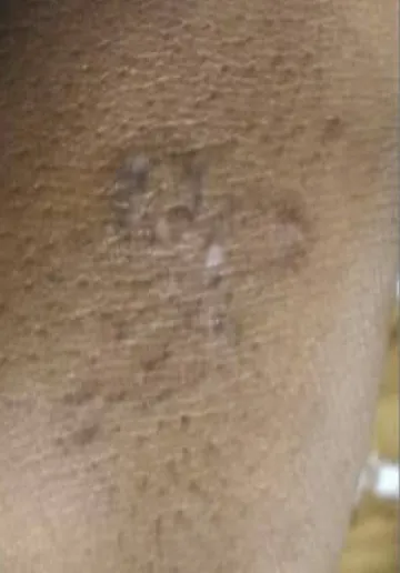 Tattoo Removal Before and after results at Dermatrix Clinic