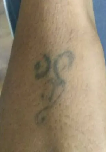 Tattoo Removal Before and after results at Dermatrix Clinic