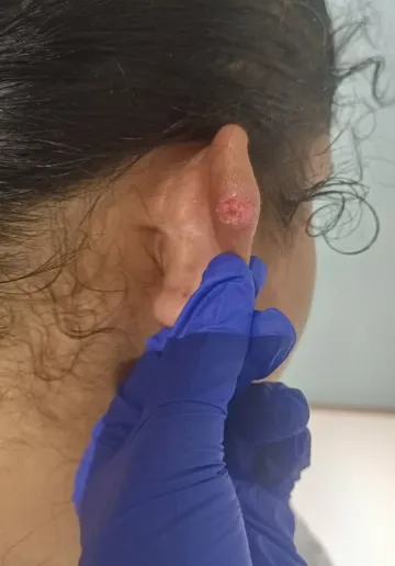 Keloid Scar Removal Before and after results at Dermatrix Clinic
