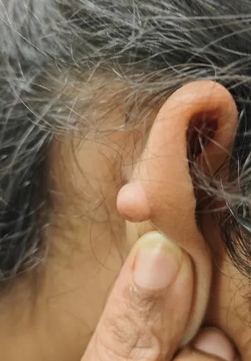 Keloid Scar Removal Before and after results at Dermatrix Clinic