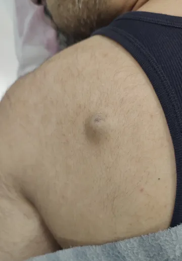 Cyst Removal Before and after results at Dermatrix Clinic