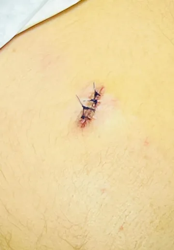 Cyst Removal Before and after results at Dermatrix Clinic