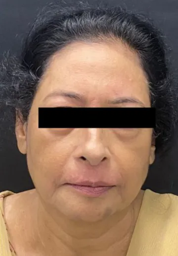 Dermal Fillers Before and after results at Dermatrix Clinic