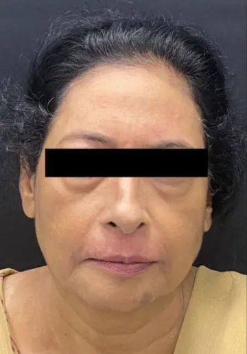 Dermal Fillers Before and after results at Dermatrix Clinic