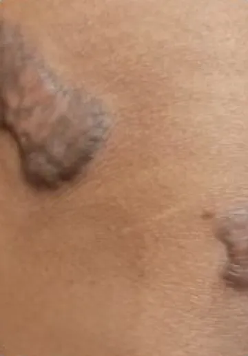 Keloid Scar Removal Before and after results at Dermatrix Clinic