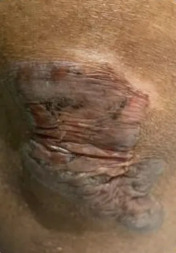Keloid Scar Removal Before and after results at Dermatrix Clinic