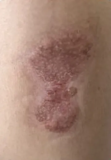 Keloid Scar Removal Before and after results at Dermatrix Clinic