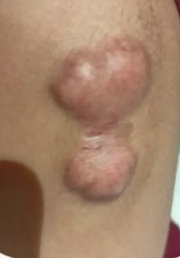 Keloid Scar Removal Before and after results at Dermatrix Clinic