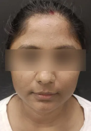 Signature Facial Before and after results at Dermatrix Clinic
